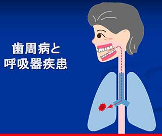 歯周病と呼吸器