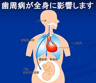 歯周病と全身