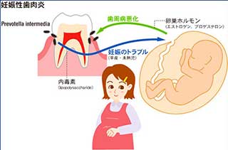 歯周病と妊娠